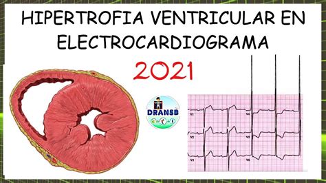 hipertrofia ventricular cie 10